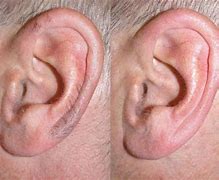 Image result for Loose Hair in Ear Canal