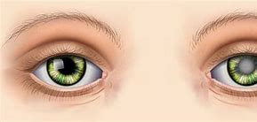 Image result for Cataract Surgery Lens
