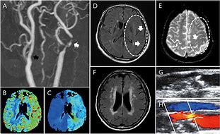 Image result for Carotid Body Angiography