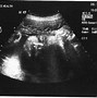 Image result for Birth at 30 Weeks