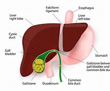 Image result for Gallstone