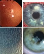 Image result for Undercorrection of Corneal Refractive Surgery