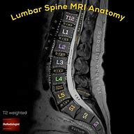 Image result for T2 Lumbar Spine MRI