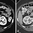 Image result for Endocrine Tumor in Pancreas