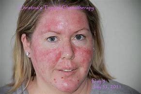Image result for Topical Chemotherapy