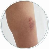 Image result for Common Skin Infections