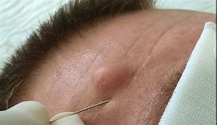 Image result for Sebaceous Cyst On Face