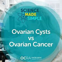 Image result for Cancerous Ovarian Cyst