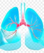 Image result for Benign Lung Tumor