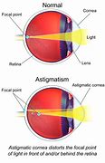 Image result for Astigmatism Eye Shape