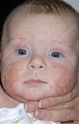 Image result for Eczema Early Stages