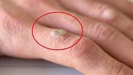 Image result for How to Get Rid Warts On Hands