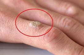 Image result for How to Get Rid of Warts On Palm of Hand