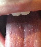 Image result for Sore Throat Back of Tongue