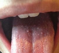 Image result for Tongue Warts