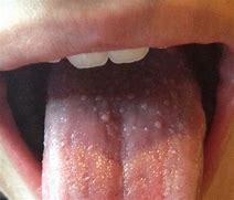 Image result for Bubbles On Back of Tongue