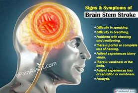 Image result for Brain Stem Stroke