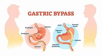 Image result for Common Channel Gastric Bypass