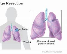 Image result for Wedge Resection Lung Surgery
