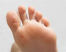 Image result for Plantar Wart On Hand