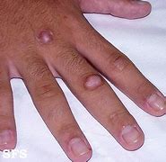 Image result for Red Bumps On Knuckles