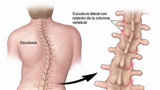 Image result for escoliosis