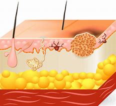 Image result for Basal Cell Mole