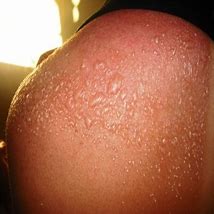 Image result for Worst Sunburn Blister