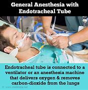 Image result for Post Anesthesia Recovery