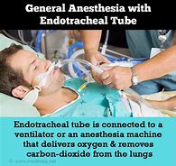 Image result for Pateint Recovery From Anesthesia