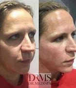 Image result for 36 Pin Micro Needling for Deep Wrinkles