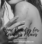 Image result for Keratosis Pilaris Scalp Hair Loss