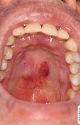 Image result for Mucosa Contagiosum