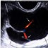 Image result for Cyst On Right Ovary