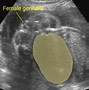 Image result for Ovarian Cyst Diagram
