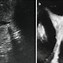 Image result for Pedunculated Polyp Uterus