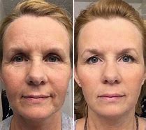Image result for Face Lift Exercises