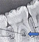 Image result for Alveolar Bone Anatomy