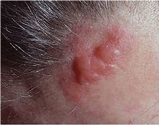 Image result for Lymphoma Skin Lesions