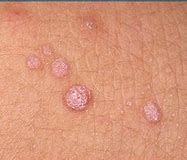 Image result for Ring Wart Treatment