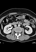 Image result for Normal Kidney CT Scan