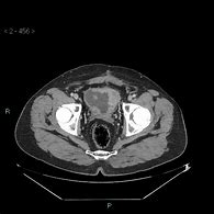 Image result for Cauterize Bladder Tumor