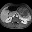 Image result for Pseudopapillary Tumor Pancreas
