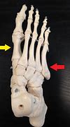 Image result for Jones Fracture