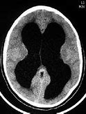 Image result for Hydrocephalus Brain Scan