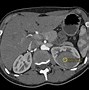 Image result for Kidney Cyst CT Scan