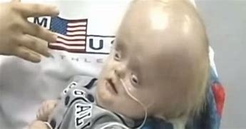 Image result for Child Born without Brain