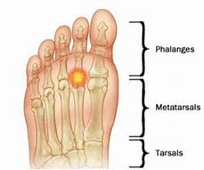 Image result for Synovitis in Turkey's