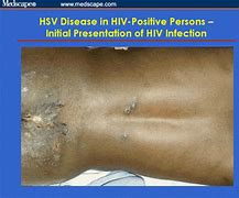 Image result for HSV-2 Disease