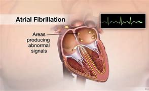 Image result for Ventricular Fibrillation